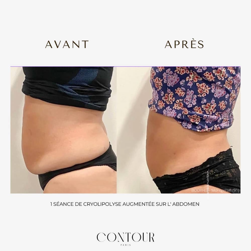 Avant Après Cryolipolyse Contour 360 à Nancy Sublim' & Vous (5)